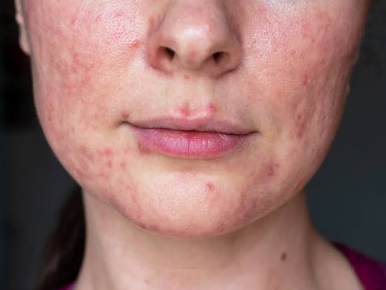 Snail Cream: Why It’s a Skincare Must-Have