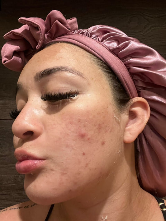 Is your skin barrier damaged? The signs & 3 steps to fix it."