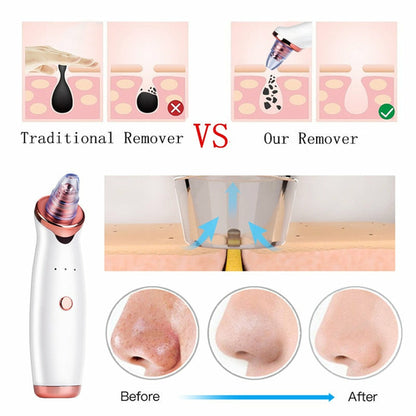 Electric Vacuum Facial Blackhead Remover Machine.